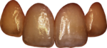 Schmelz dentin frontal.png